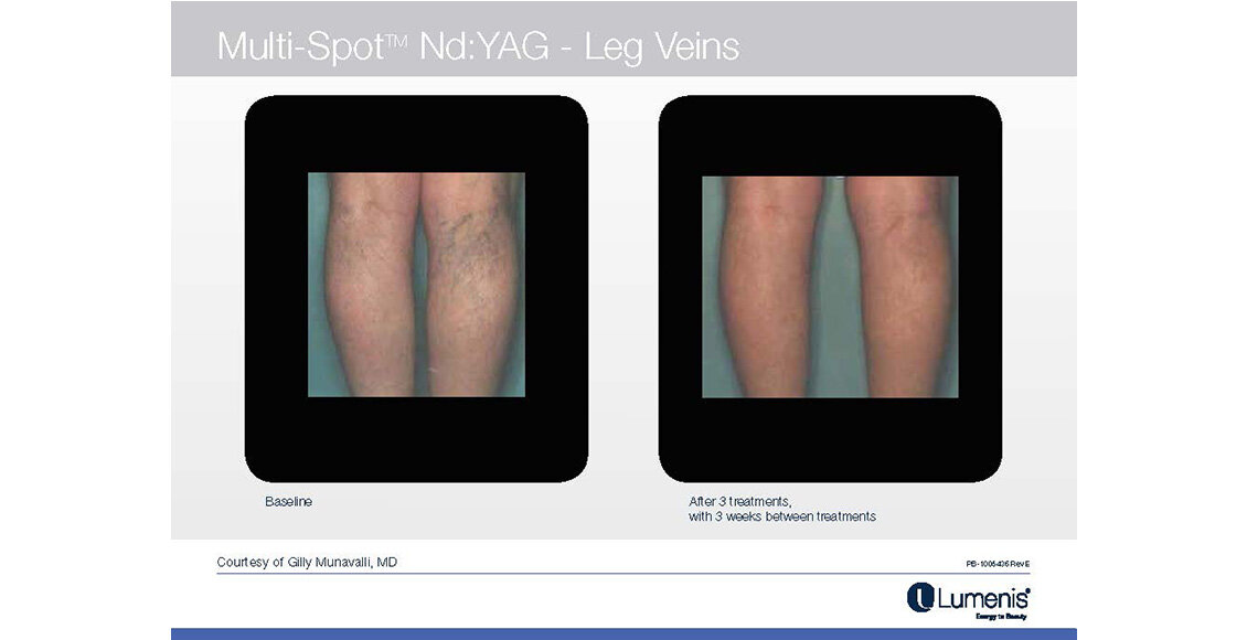 Before-and-after-results-leg-veins-M22-Module-6-NEW
