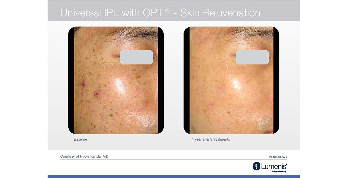 Before-and-after-results-sun-damage-IPL-M22-Module-6-NEW