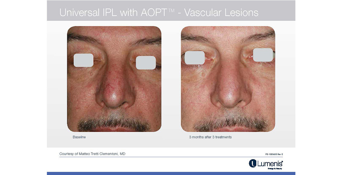M22-Before-and-after-IPL-Vascular-Lesions-Facial-VeinsResults-photos-Page-047